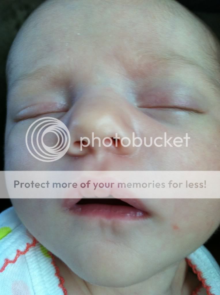 Anyone else LO's lips peeling? *pic* BabyCenter